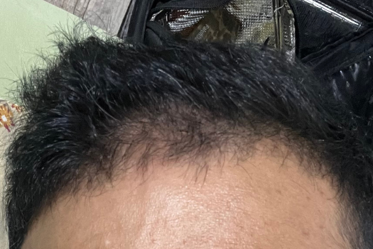 How to Know if Hair Loss is From Stress