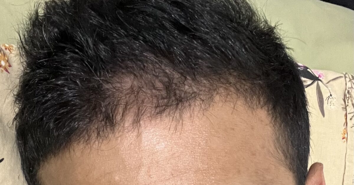 Hair thinning in front