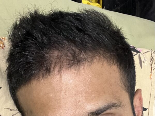 Hair thinning in front