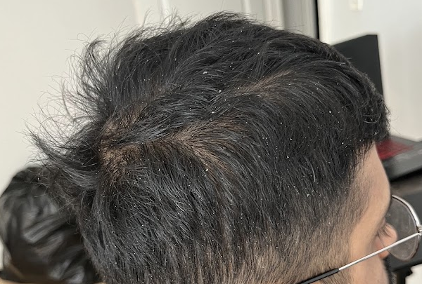Dandruff on my thin hair