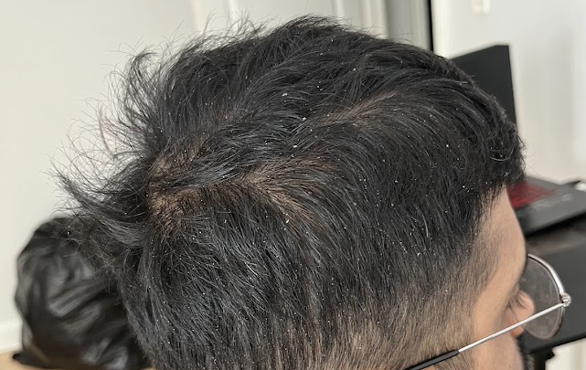 Dandruff on my thin hair