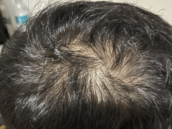 Does Hair Regrowth Make Your Scalp Itch