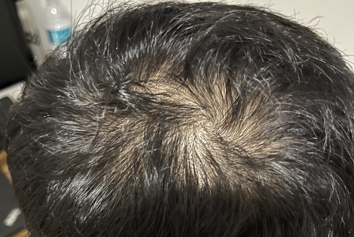 Does Hair Regrowth Make Your Scalp Itch