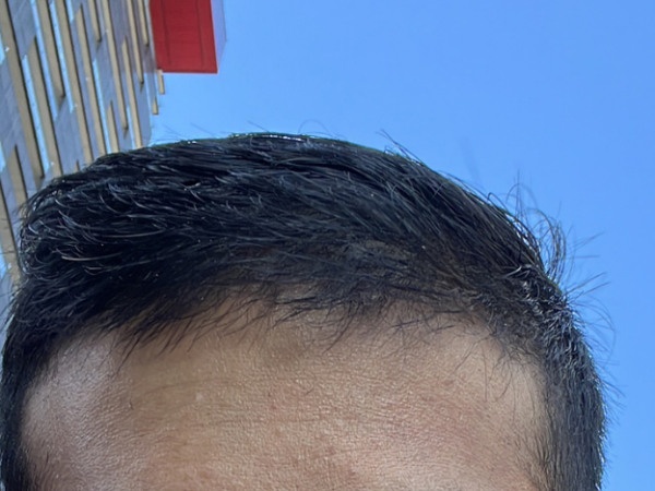 Is It Possible to Regrow Hair on a Bald Spot