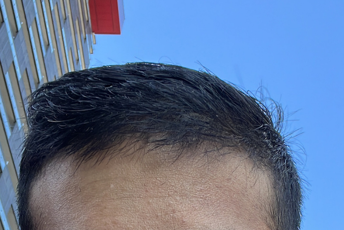 Is It Possible to Regrow Hair on a Bald Spot