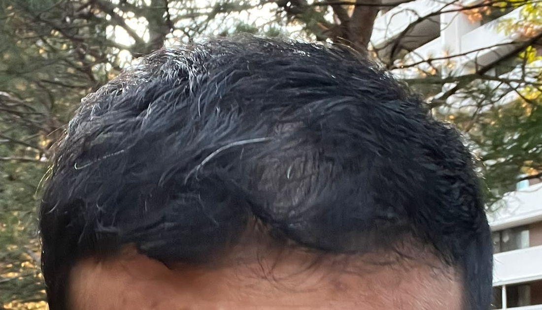 How to Improve the Health of Thinning Men's Hair
