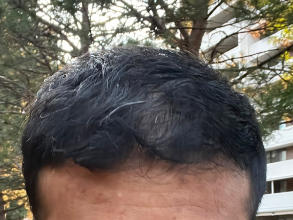 How to Improve the Health of Thinning Men's Hair