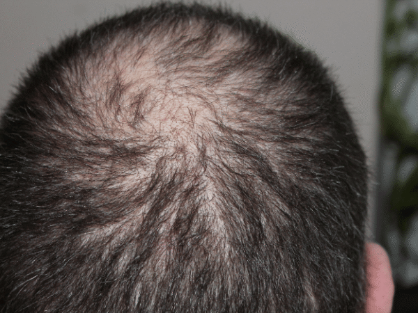 How to Slow Hair Thinning