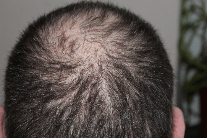 How to Slow Hair Thinning