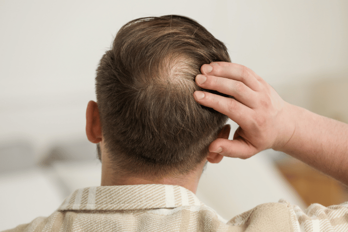 What to Do for Thinning Hair on Top of Head