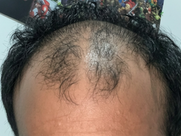 What Causes Thinning Hair