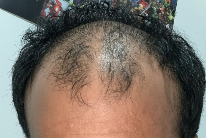 What Causes Thinning Hair