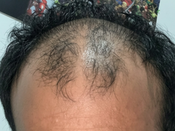 frontal hair thinning