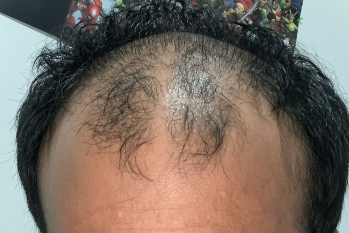 frontal hair thinning